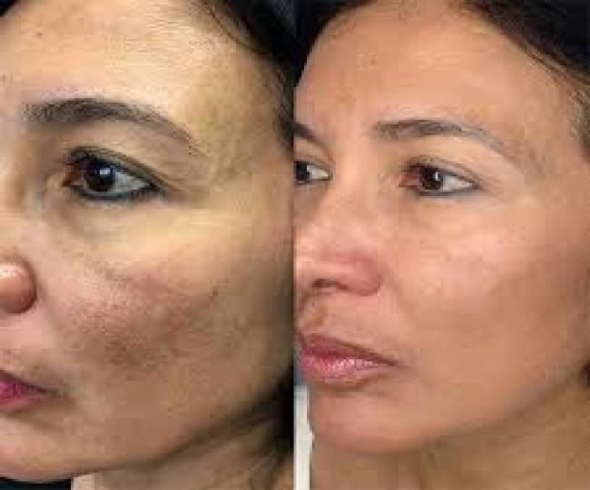 Vampire Facelift Treatment Clinic in Jodhpur