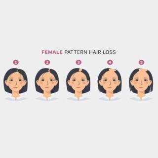 Women Female Hair Transplant Clinic in Ganganagar